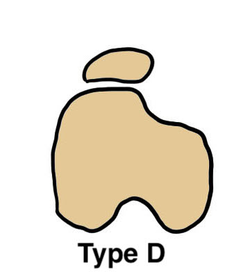 Type D