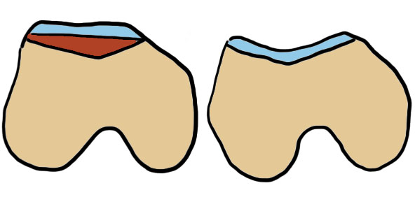 Trochleoplasty