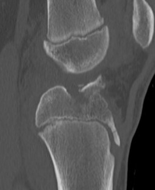 tibial spine