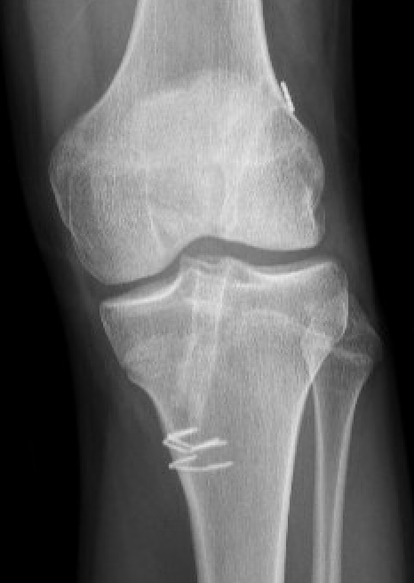 Angular deformity