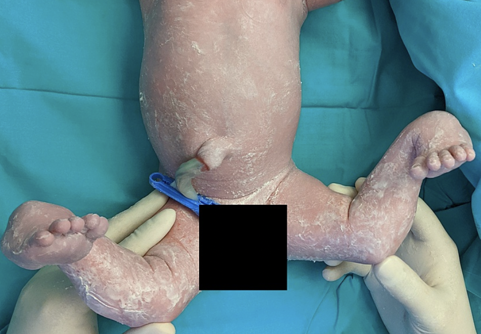 Congenital knee dislocation