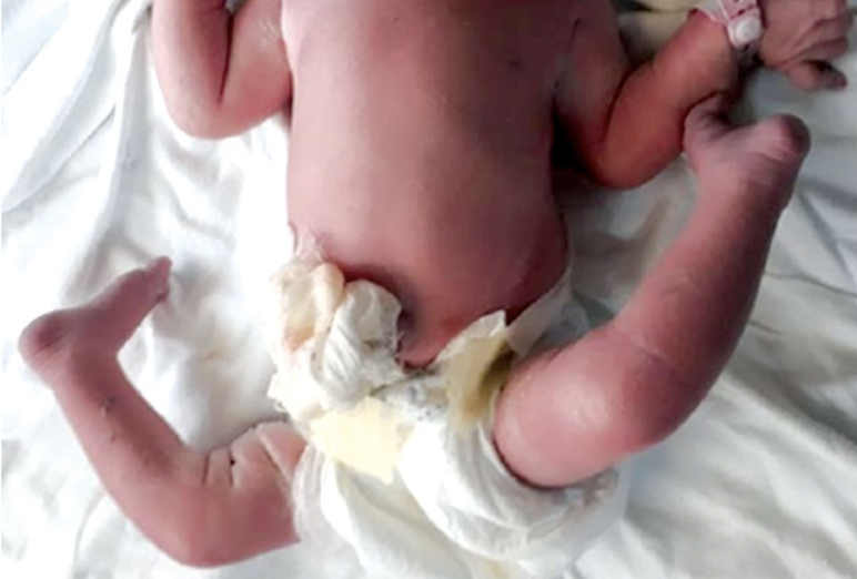Congenital knee dislocation