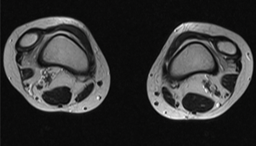 MRI