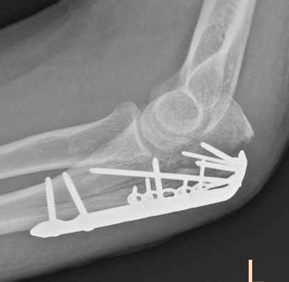 Failure fixation