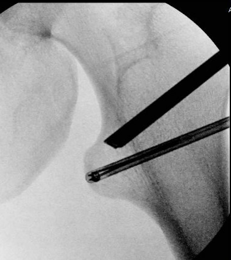 LT resection
