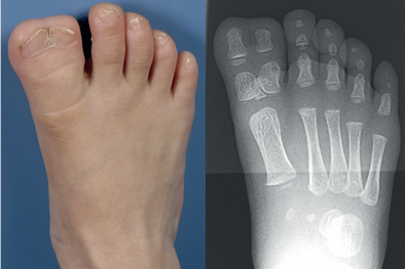 Polydactyly