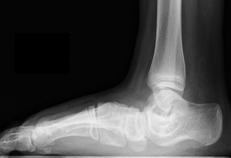 Skewfoot