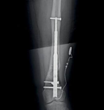Fitbone