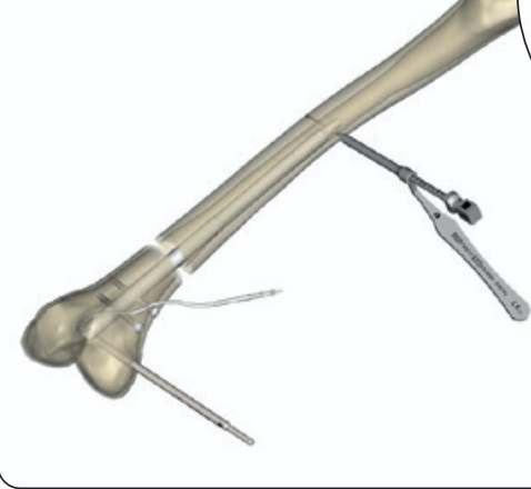 Fitbone femoral nail