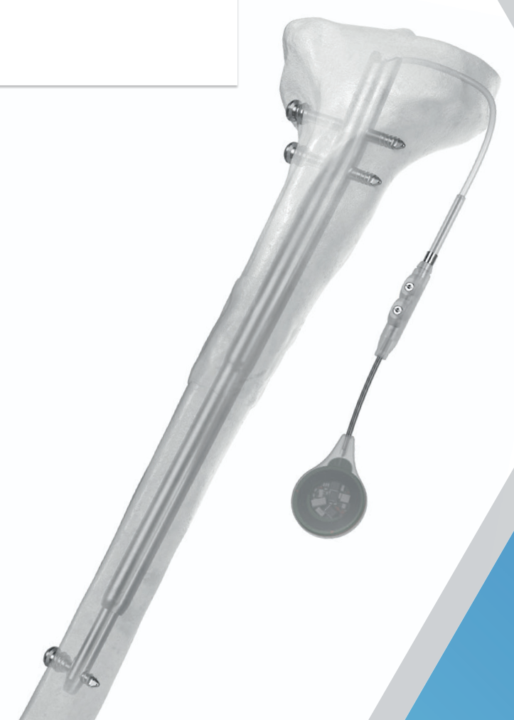 Fitbone tibia