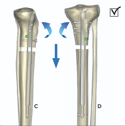 Fitbone tibia