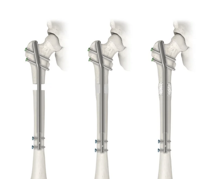 Precice femoral nail