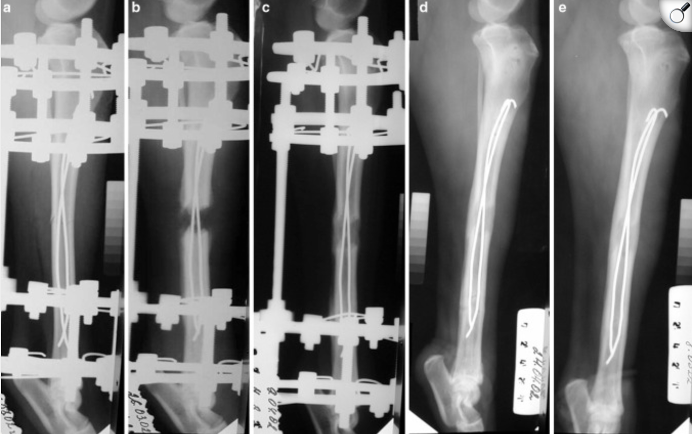 External fixation