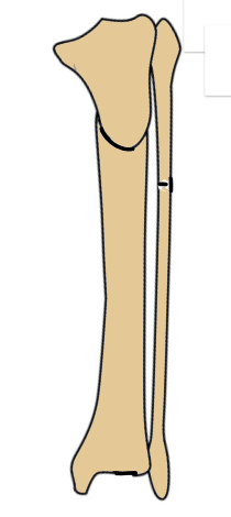 Rab osteotomy