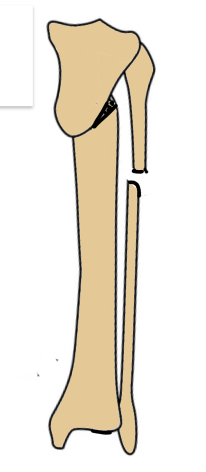 Rab osteotomy