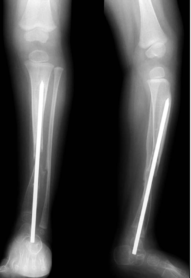 Tibial pseudoarthrosis