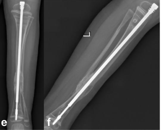 Teloscopic rod