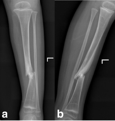 Congenital pseudoarthrosis tibia