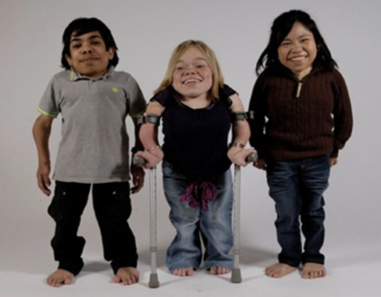 Morquio's syndrome