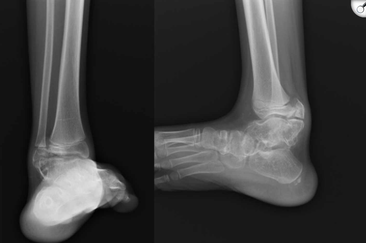Trevors disease