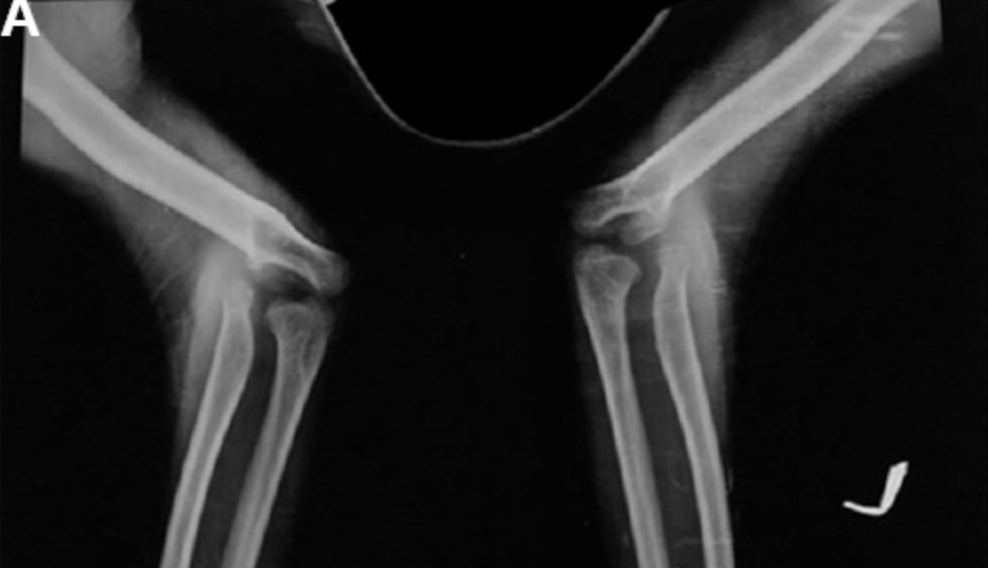 Nail patella