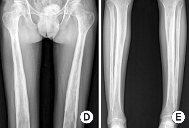 Diaphyseal dysplasia