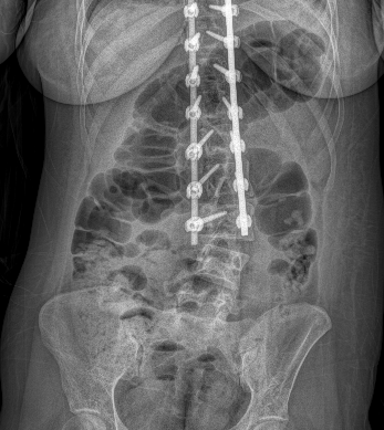 Scoliosis