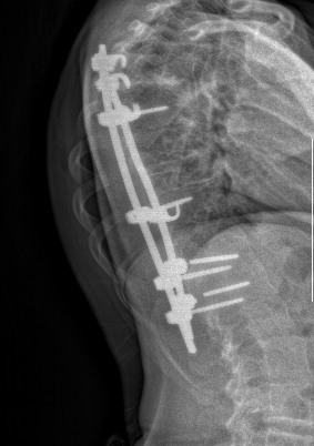 Scoliiosis