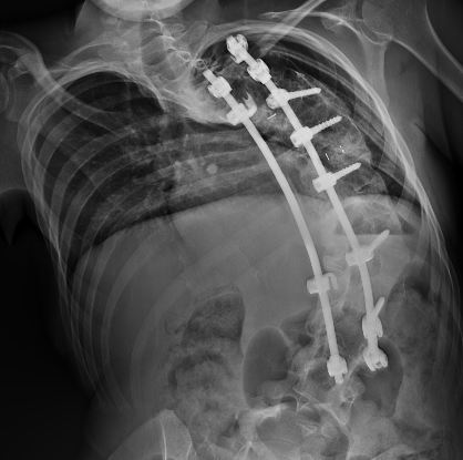 NM scoliosis