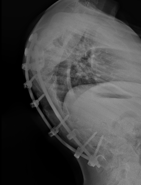 NM scoliosis