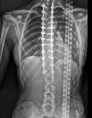 Thoracic