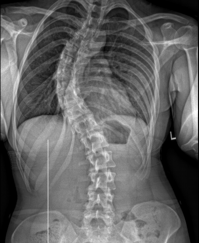 Thoracic