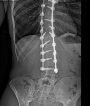 scoliosis