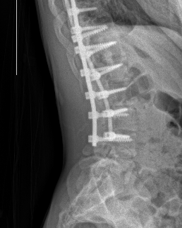 scoliosis