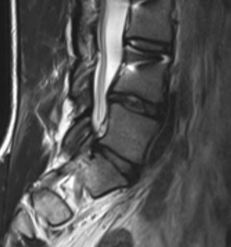 Scoliosis