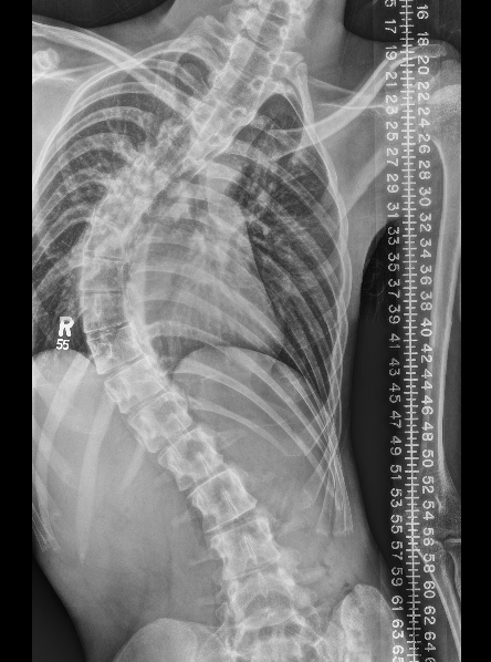 CP scoliosis