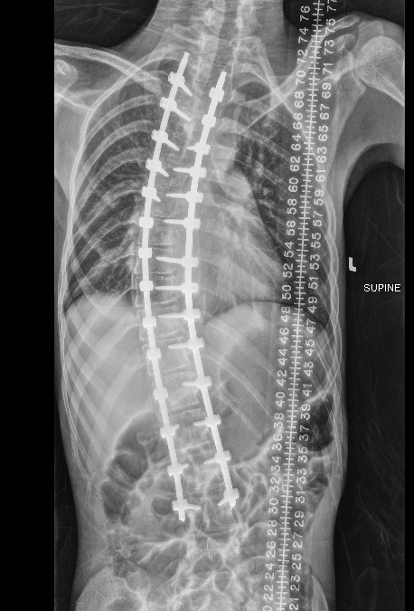 Scoliosis