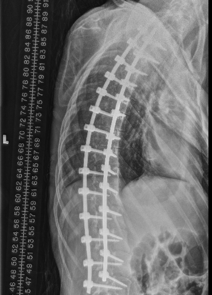 Scoliosis