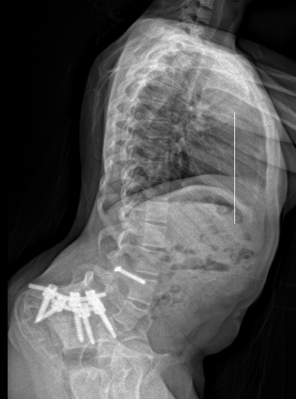 OI spine