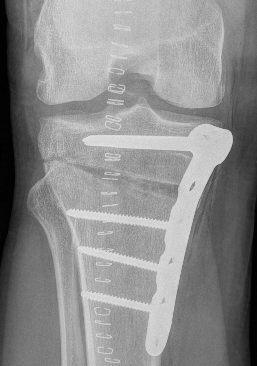 LATERAL HINGE