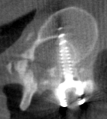 Scoliosis