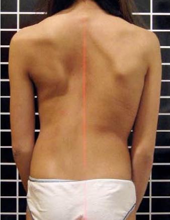 Scoliosis