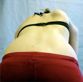 scoliosis