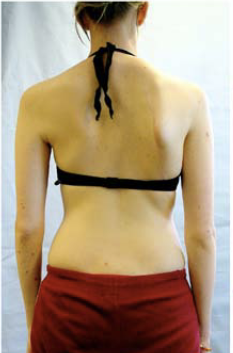 scoliosis