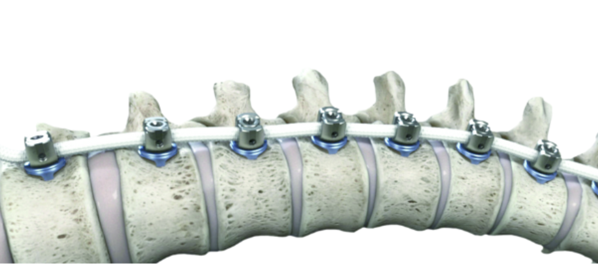 Anterior vertebral body tethering