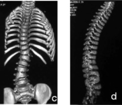 Congenital scoliosis