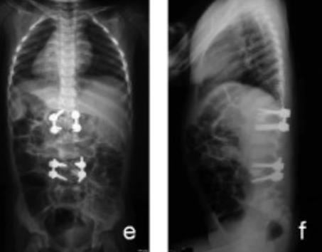 Congenital scoliosis