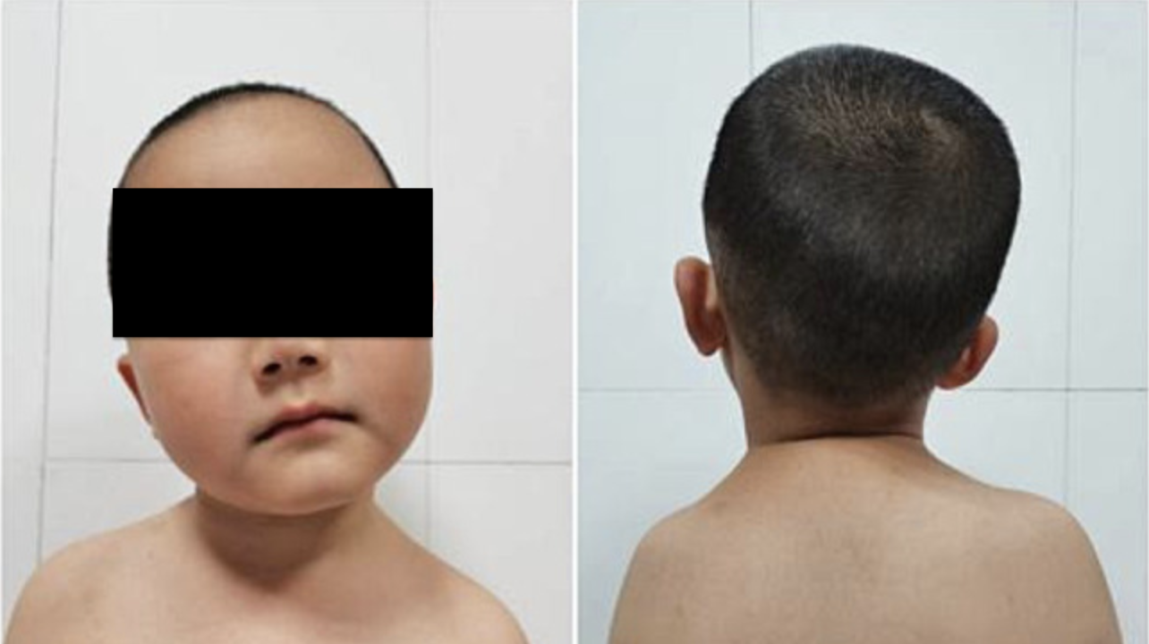 Torticollis