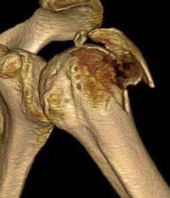 GT fracture