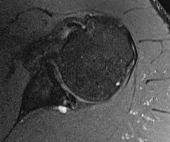 posterior labrum